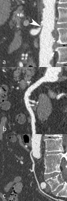 Prevalence and Prognostic Value of Mesenteric Artery Stenosis in Patients Undergoing Transcatheter Aortic Valve Implantation